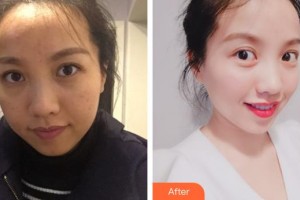 上海美爾雅醫(yī)療美容醫(yī)院劉麒整形價(jià)格表附巨補(bǔ)水祛除暗沉淡化眼紋案例展示
