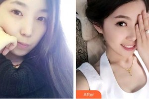 上海原辰醫(yī)療美容醫(yī)院王博整形價(jià)格表附牙齒隱形矯正案例展示