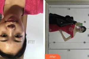 上海伊美爾港華醫(yī)療美容醫(yī)院盧宏整形價(jià)格表附點(diǎn)陣激光案例展示