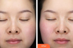 上海柏漫醫(yī)療美容診所趙禹翔整形價(jià)格表附面雕下頜緣案例展示