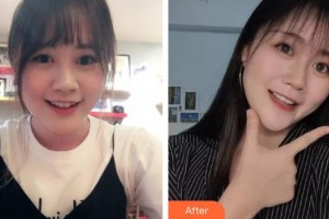 上海顏夢(mèng)醫(yī)療美容門診部楊璐整形價(jià)格表附眼部手術(shù)案例展示