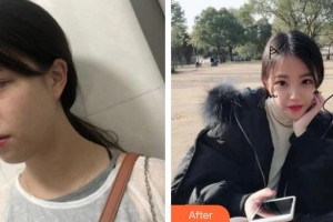 上海百達麗醫(yī)療美容醫(yī)院談宇騰整形價格表附切開雙眼皮案例展示