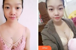 上海保加醫(yī)療美容門診部Tony整形價格表附濃縮脂肪豐胸案例展示