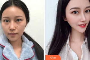 上海時光整形外科醫(yī)院唐鏖整形價格表附補水嫩膚抗衰案例展示