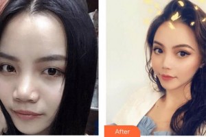 上海保加醫(yī)療美容門診部楊勇整形價格表附硅膠鼻部手術(shù)案例展示