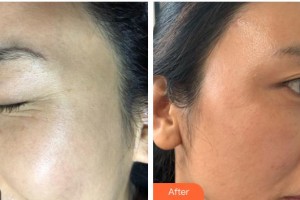 上海文峰醫(yī)療美容門診部潘杰整形價格表附超激光美膚祛斑案例展示