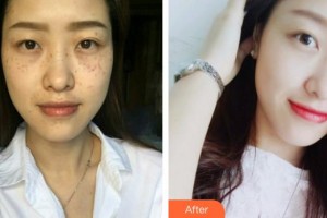 上海時光整形外科醫(yī)院張曉梅整形價格表附超激光美膚祛斑案例展示