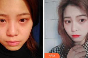 上海百達麗醫(yī)療美容醫(yī)院張程整形價格表附激光美膚激光案例展示