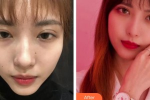 上海105醫(yī)院整形美容中心倪少杰整形價格表附下頜角磨骨案例展示