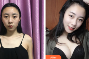 廣州中家醫(yī)家庭醫(yī)生醫(yī)學(xué)整形美容醫(yī)院黃廣香整形價(jià)格表附娜琦麗假體隆胸案例展示