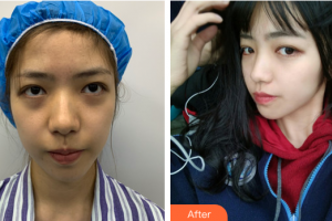 廣州時(shí)光整形美容醫(yī)院鐘涌濤整形價(jià)格表附面部埋線提升案例展示