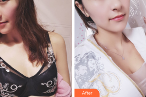 廣州美萊醫(yī)療美容醫(yī)院羅延平整形價(jià)格表附濃縮豐胸案例展示