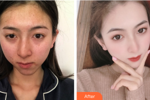 廣州博仕整形美容醫(yī)院王加凌整形價(jià)格表附健康素顏肌+牛奶酸案例展示