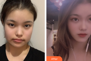 廣州曙光醫(yī)學(xué)美容醫(yī)院張小蕓整形價(jià)格表附自然V臉型案例展示