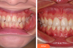 廣州利美康粵美醫(yī)療美容門診部艾虹整形價(jià)格表附牙齒正畸案例展示