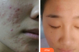 廣州韓妃醫(yī)學(xué)美容醫(yī)院陳坦整形價(jià)格表附激光祛痘坑痘印案例展示