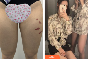 廣州美瑞兒醫(yī)療美容門診部崔錫珉整形價(jià)格表附大腿吸脂案例展示