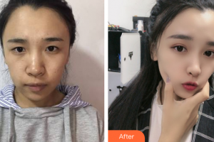 廣州美瑞兒醫(yī)療美容門診部金炳鍵整形價(jià)格表附眼部綜合案例展示