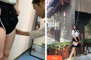 廣州荔醫(yī)醫(yī)療美容門診部鄧正軍整形價格表附大腿吸脂案例展示