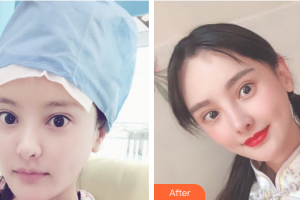 廣州慕美醫(yī)療美容醫(yī)院成紅整形價格表附發(fā)際線種植案例展示