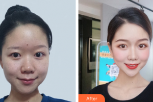 廣州韓妃醫(yī)學美容醫(yī)院孫華整形價格表附激光祛斑案例展示