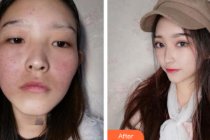 廣州利美康粵美醫(yī)療美容門診部龔麗珍美容科激光師整形價格表附皮膚管理案例展示