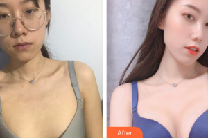 廣州市第一人民醫(yī)院整形美容中心王原路整形價格表附濃縮豐胸案例展示