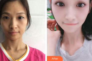 廣州中家醫(yī)家庭醫(yī)生醫(yī)學整形美容醫(yī)院鄭昱喆整形價格表附蘿莉美萌眼案例展示