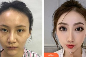 上海百達麗醫(yī)療美容醫(yī)院趙平萍整形價格表附鼻部手術(shù)整形案例展示