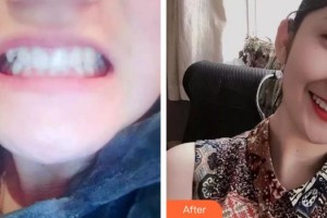 上海百達麗醫(yī)療美容醫(yī)院李琪整形價格表附牙齒正畸案例展示