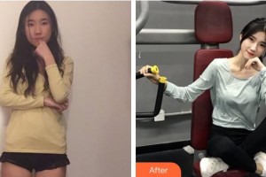 上海解放軍第四五五醫(yī)院激光整形科羅玲整形價格表附玻尿酸導入案例展示