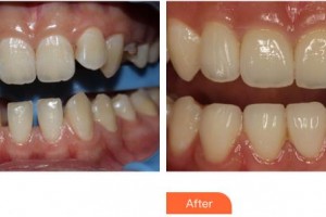 上海百達麗醫(yī)療美容醫(yī)院孫波整形價格表附口腔隱形矯正案例展示