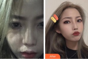 上海仁愛醫(yī)院整形美容科朱啟剛整形價格表附毛發(fā)種植案例展示