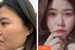 上海萬眾醫(yī)院醫(yī)療美容科江超超整形價格表附點陣激光祛痘坑毛孔案例展示