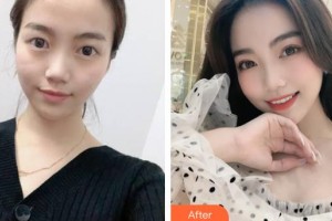 武警上?？傟犪t(yī)院整形美容中心游萬福整形價格表附無針水光案例展示