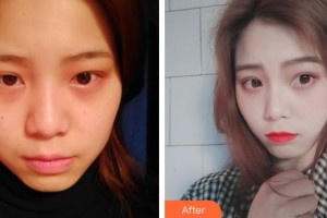 上海美爾雅醫(yī)療美容醫(yī)院張玉麟整形價格表附光子嫩膚案例展示