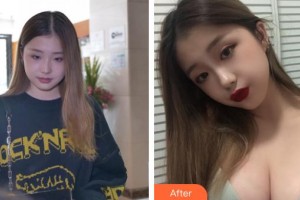 上海明橋醫(yī)療美容門診部金關(guān)鍵整形價格表附假體隆胸案例展示