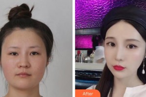 上海仁濟(jì)醫(yī)院整形外科祝家學(xué)整形價(jià)格表附面部整形案例展示