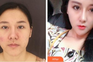 上海仁濟(jì)醫(yī)院整形外科徐海淞整形價(jià)格表附面部吸脂案例展示