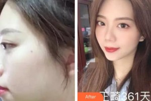 上海二醫(yī)大附屬第九人民醫(yī)院整形激光美容中心周國(guó)瑜整形價(jià)格表附牙齒矯正案例展示