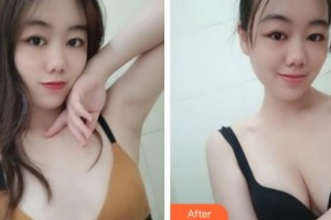 上海玫瑰醫(yī)療美容醫(yī)院郭世偉整形價(jià)格表附濃縮豐胸案例展示