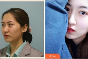 上海仁愛醫(yī)院整形美容科戴君來整形價(jià)格表附光子套餐案例展示