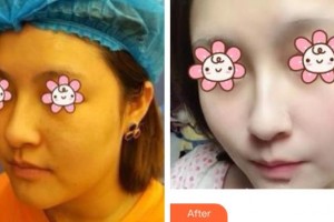 上海博愛醫(yī)院整形科傅文鳳整形價格表附激光祛斑案例展示