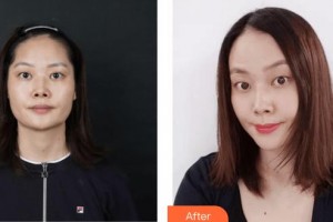 上海康奧醫(yī)療美容醫(yī)院胡康容整形價(jià)格表附光子嫩膚案例展示