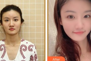 上海伊萊美醫(yī)療美容醫(yī)院何生靜整形價(jià)格表附曬后修復(fù)案例展示