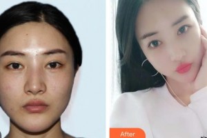 上海申德醫(yī)院醫(yī)療美容科金恩洙整形價(jià)格表附·顴骨內(nèi)推案例展示