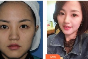 上海光博士醫(yī)療美容門(mén)診部錢(qián)雪華整形價(jià)格表附光子嫩膚案例展示