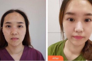 上海市皮膚病醫(yī)院醫(yī)療美容科章偉整形價(jià)格表附激光祛痣點(diǎn)痣案例展示