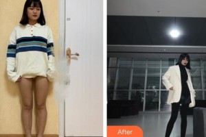 上海復(fù)麗醫(yī)療美容門(mén)診部張家偉整形價(jià)格表附吸脂瘦大腿案例展示