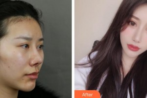 上?？叼愥t(yī)療美容門(mén)診部魏艷玲整形價(jià)格表附顴骨+夾脂墊案例展示